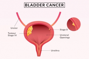 Unveiling Bladder Cancer: Exploring Types and Varieties of Cancer