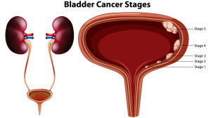 Empowering Hope: Understanding Bladder Cancer, Exploring Immunotherapy in India